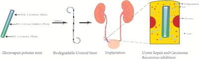 Recent development and future application of biodegradable ureteral stents